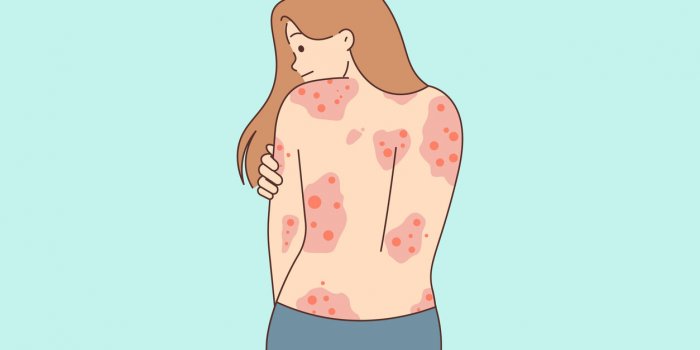 Psoriasis en gouttes : sept signes de cette maladie de la peau