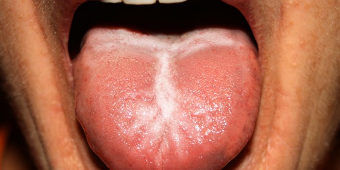Bouche sÃ¨che : 12 causes possibles