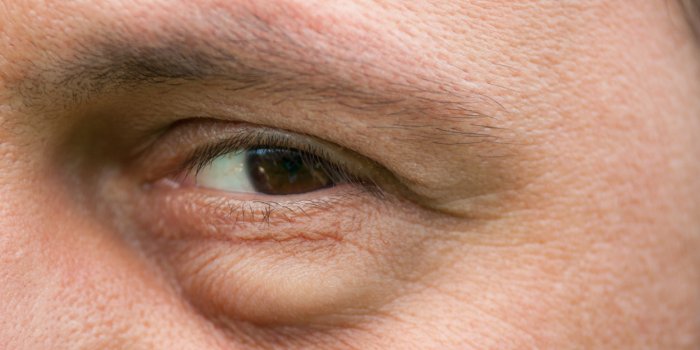 Stress, frustration, tabac... : ce que vos rides rÃ©vÃ¨lent vraiment