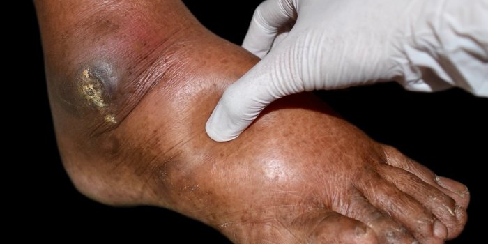 6 signes avant-coureurs de dâune maladie du foie liée à lâalcool
