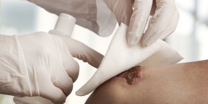 SepticÃ©mie : 7 Ã©tapes clÃ©s pour dÃ©sinfecter la plaie 