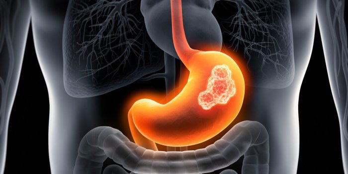 7 risques associés aux médicaments prescrits en cas de reflux, de brûlures ou dâulcère à lâestomac (IPP)