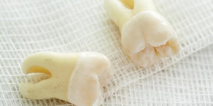 Les dents de sagesse