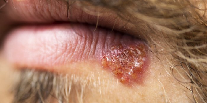 Maladies de peau : 7 huiles essentielles qui soignent !Â 