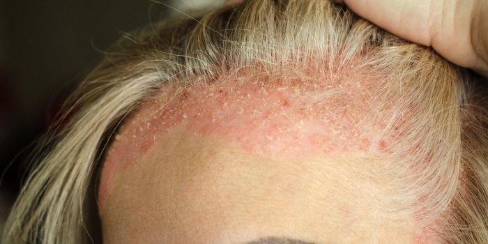 Maladies de peau : 7 huiles essentielles qui soignent !Â 