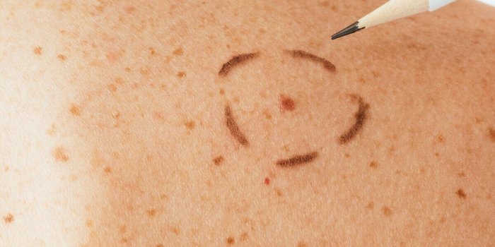Cancer de la peau : 7 signes dans votre cuir chevelu qui doivent vous alerter
