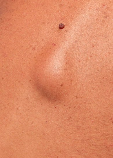 Cancer de la peau : 7 signes dans votre cuir chevelu qui doivent vous alerter