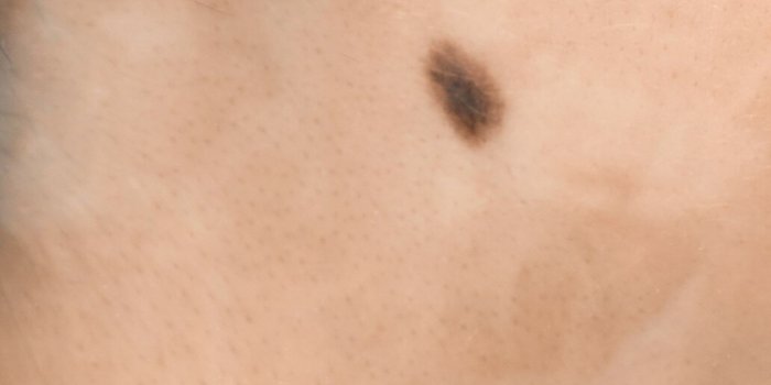 Cancer de la peau : 7 signes dans votre cuir chevelu qui doivent vous alerter
