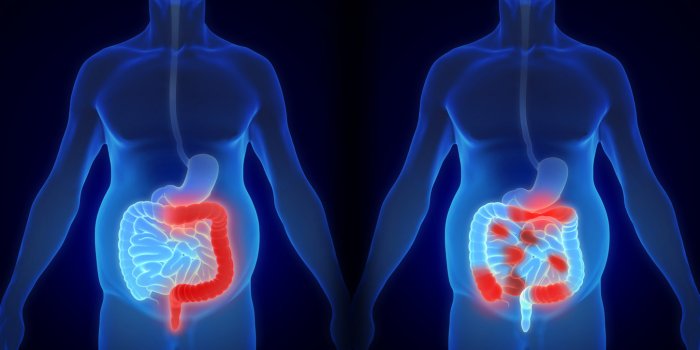 MICI : 12 idées reçues sur les maladies inflammatoires chroniques de l'intestin
