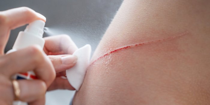 spray antiseptic on the wound on the child's back disinfection of wounds hydrogen peroxide spray cleaning flesh wound wit...