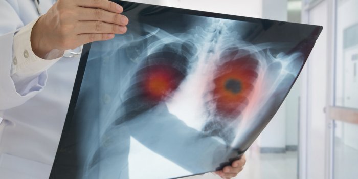 L'insuffisance cardiaque peut entraîner ces 7 maladies