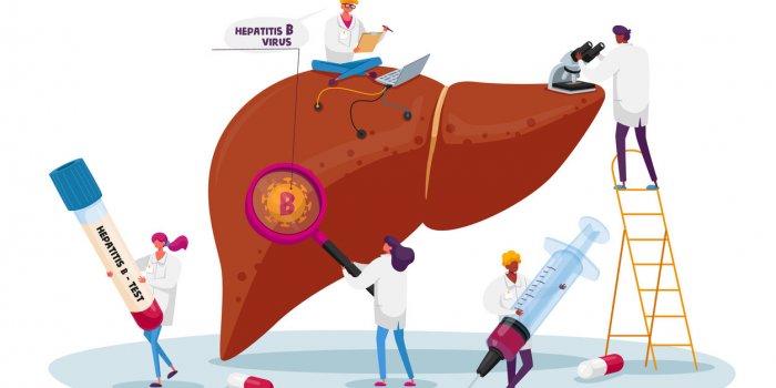 medical diagnosis hepatitis b world day, cirrhosis concept, tiny doctor characters care of huge patient diseased liver, h...