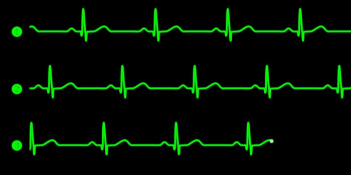Iode : 7 complications d'un surdosage