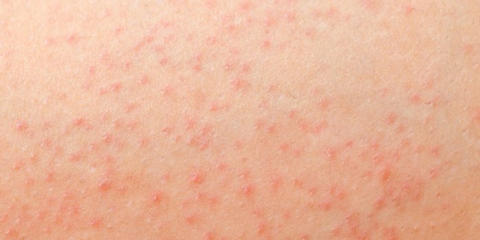 Iode : 7 complications d'un surdosage