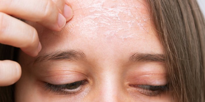 close-up of a female forehead with peeling skin isolated on a white background allergies, eczema, psoriasis, lack of vita...