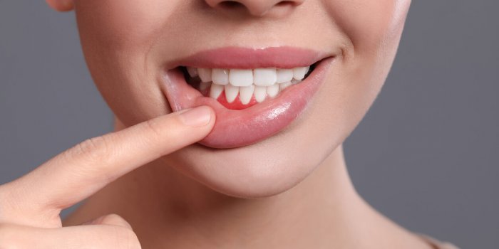 7 signes d'un microbiote buccal en mauvaise santé