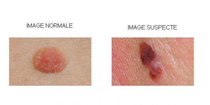 Cancer de la peau : 4 photos qui doivent alerter