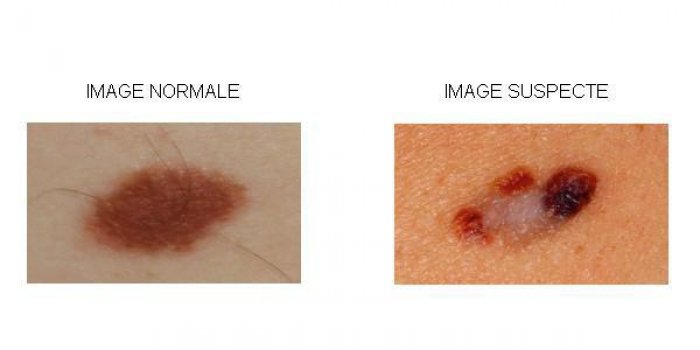 Cancer de la peau : 4 photos qui doivent alerter