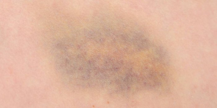 Vitamine B9 : les 10 signes de carence