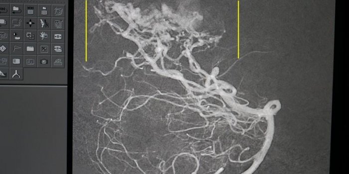 Comment réparer une malformation artério-veineuse dans le cerveau : les images au bloc