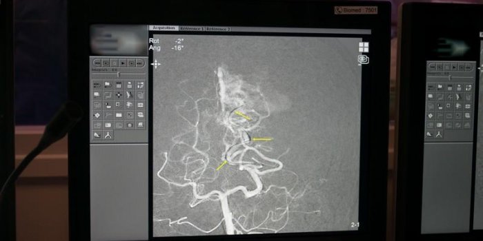 Comment réparer une malformation artério-veineuse dans le cerveau : les images au bloc