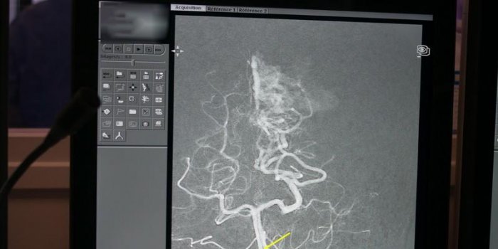 Comment réparer une malformation artério-veineuse dans le cerveau : les images au bloc