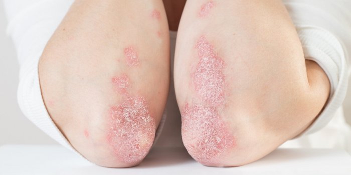 5 signes dâun problème de santé visibles sur votre coude