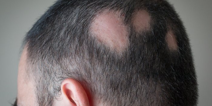 Alopécie : les causes les plus fréquentes de chute de cheveux