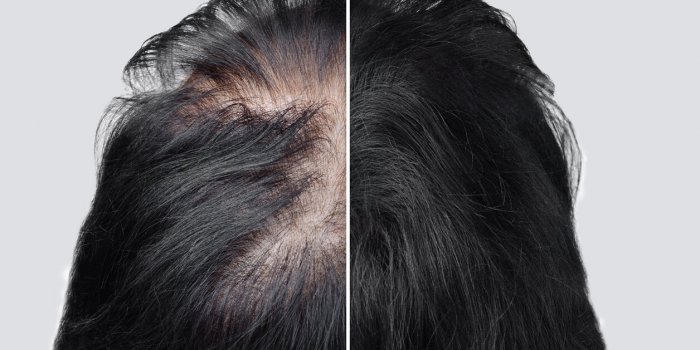 Alopécie : les causes les plus fréquentes de chute de cheveux