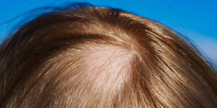 Alopécie : les causes les plus fréquentes de chute de cheveux