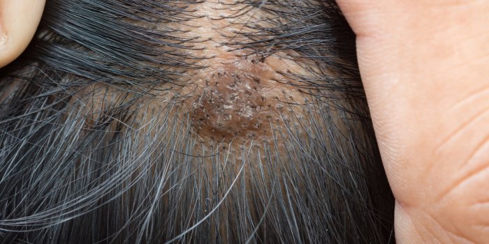 Alopécie : les causes les plus fréquentes de chute de cheveux