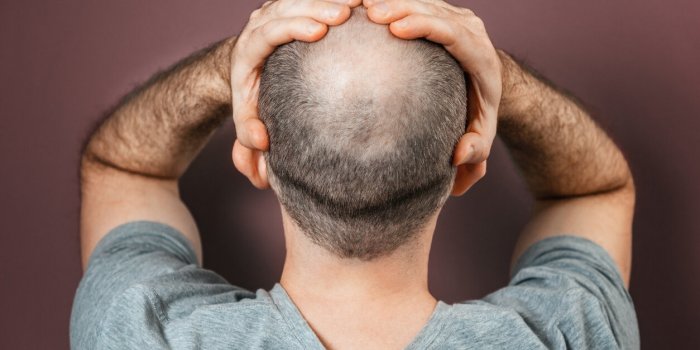 Alopécie : les causes les plus fréquentes de chute de cheveux
