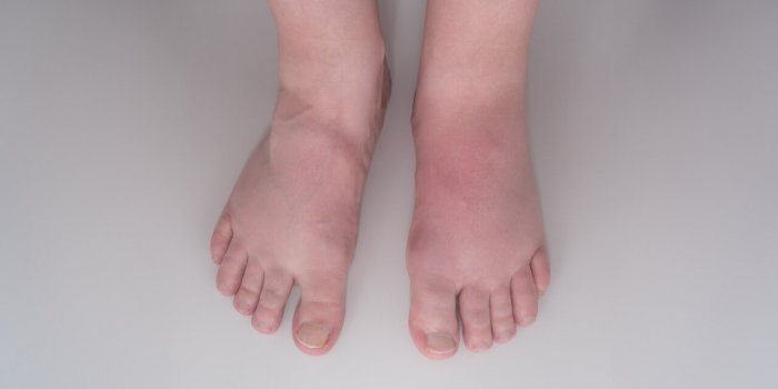 Acide urique : 6 symptÃ´mes frÃ©quents en cas de crise de goutte 