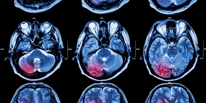 Cancer : 5 idées reçues sur les tumeurs cérébrales