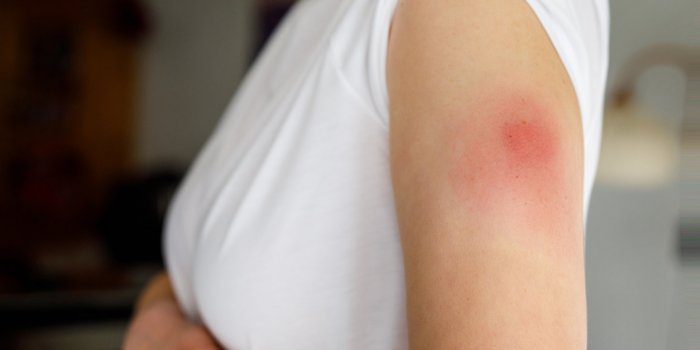 Rappel de vaccin Covid-19 : les effets secondaires les plus enregistrés par les CDC