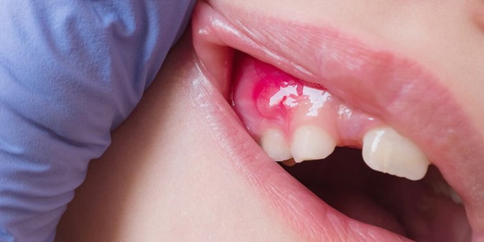 painful pus-filled swelling abscess in the gum of the mouth in a 8 year old child