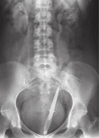 Radio : 9 objets insolites dÃ©couverts par les mÃ©decins