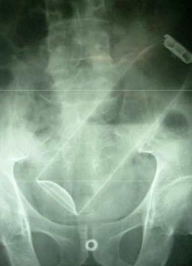Radio : 9 objets insolites dÃ©couverts par les mÃ©decins