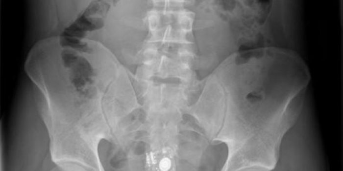 Radio : 9 objets insolites dÃ©couverts par les mÃ©decins