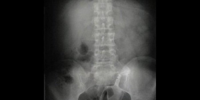 Radio : 9 objets insolites dÃ©couverts par les mÃ©decins