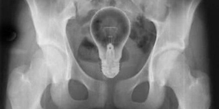 Radio : 9 objets insolites dÃ©couverts par les mÃ©decins