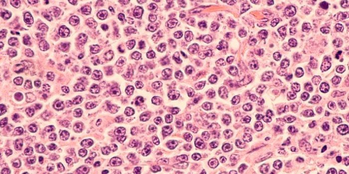 12 cancers oÃ¹ le taux de survie sâest amÃ©liorÃ©
