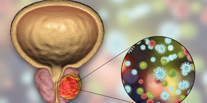 Cancer : les Ã¢ges oÃ¹ vous Ãªtes le plus Ã  risque