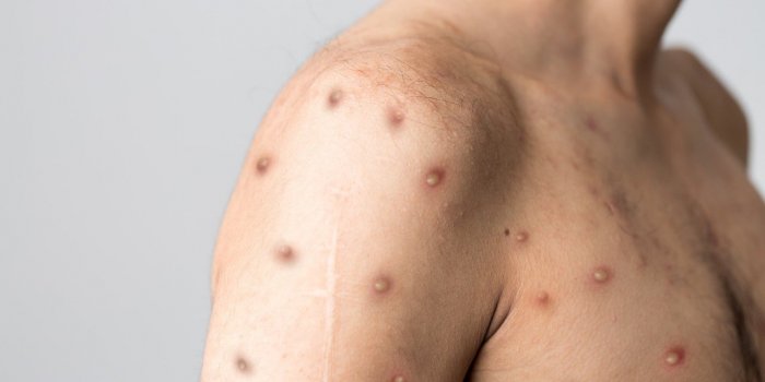 Variole du singe : quels sont les symptÃ´mes d'alerte ?