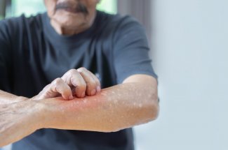 Un vaccin contre l’eczema arrive en France !