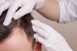 Perte de cheveux : avez-vous pense a la greffe capillaire ?