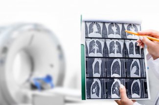 Cancer du poumon : qui devrait se faire depister ?