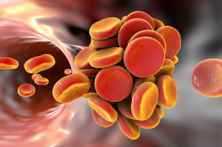 Thrombose : moins de risques avec le vaccin qu-en ayant le coronavirus ?