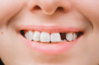 Osteoporose : les medicaments vous font-ils vraiment perdre vos dents ?