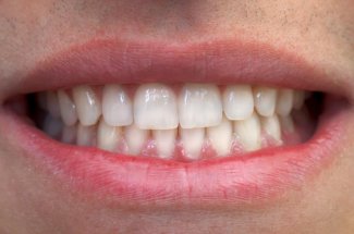 Les femmes ayant perdu des dents sont plus a risque d’hypertension arterielle